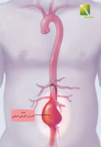 aortic aneurysm1