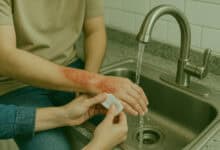 burn first aid