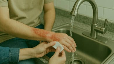 burn first aid